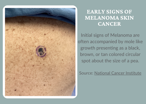 Melanoma Skin Cancer Growth