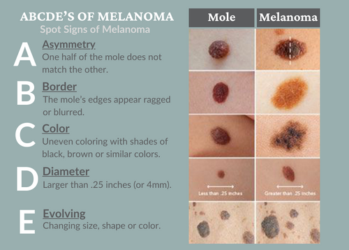 ABCDEs of Melanoma Chart