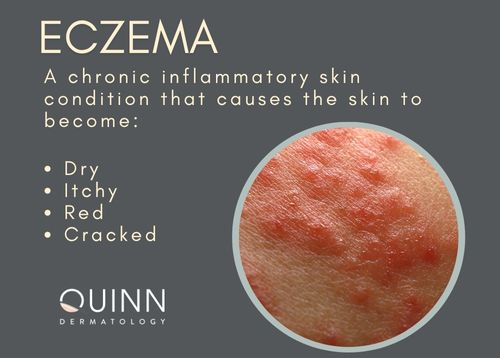 Eczema treatments, Quinn Dermatology
