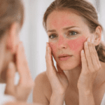 rosacea treatment in Houston and Beaumont