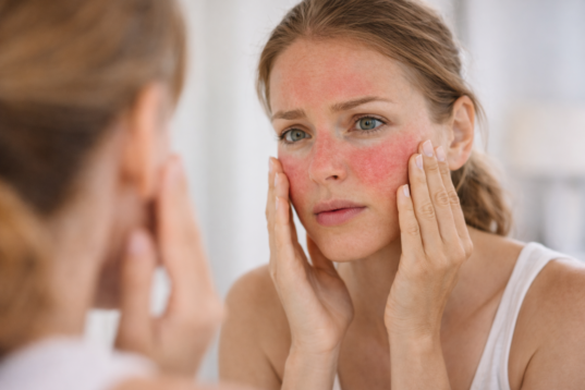 rosacea treatment in Houston and Beaumont