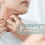 Spring Eczema Flare-Ups